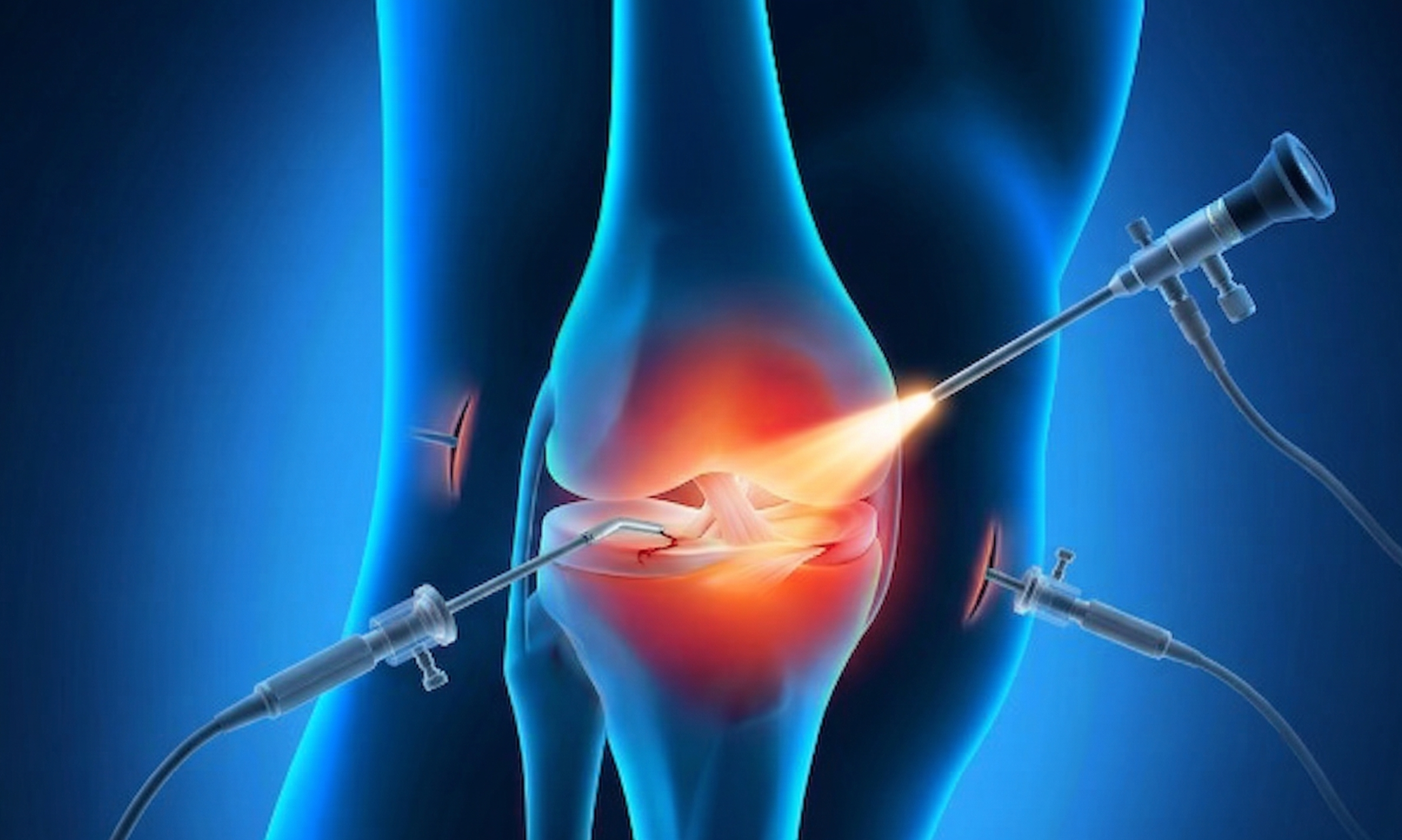 Arthroscopie du genou